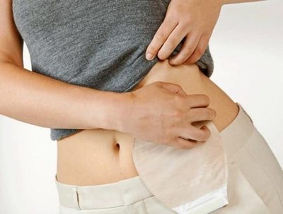 Escasean bolsas colectoras para pacientes ostomizados del IPS · Radio Monumental 1080 AM