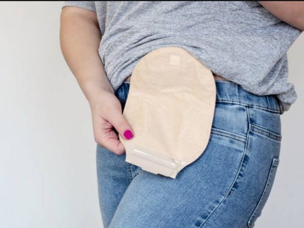 Pacientes ostomizados usan bolsa de súper y de hielo