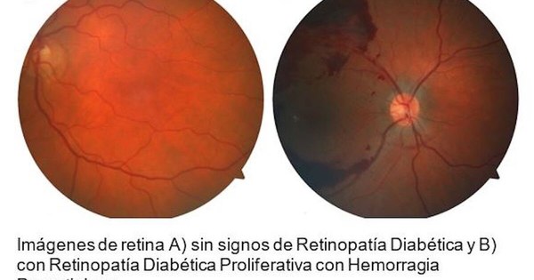 La Nación / Buscan prevenir pérdida de la visión por diabetes
