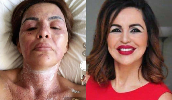 Precandidata a concejal denuncia que en una estética le desfiguraron el rostro - Noticiero Paraguay