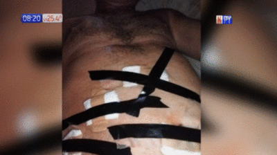 Inhumano: Paciente sostuvo sus gasas con cinta aislante en hospital | Noticias Paraguay