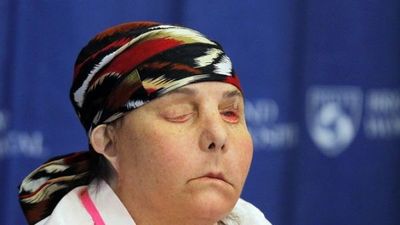 La primera persona en recibir dos trasplantes de cara en EE.UU