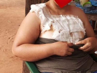 Se quemó con agua caliente y la despidieron
