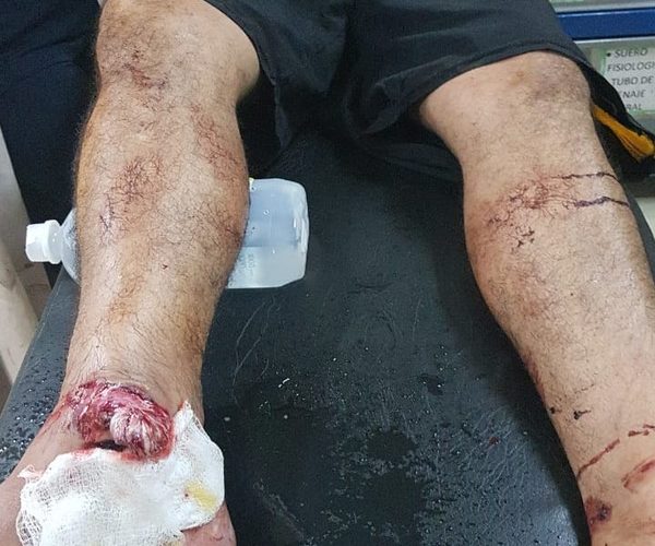 Se dislocó el tobillo, tratando de escapar de agentes policiales – Diario TNPRESS