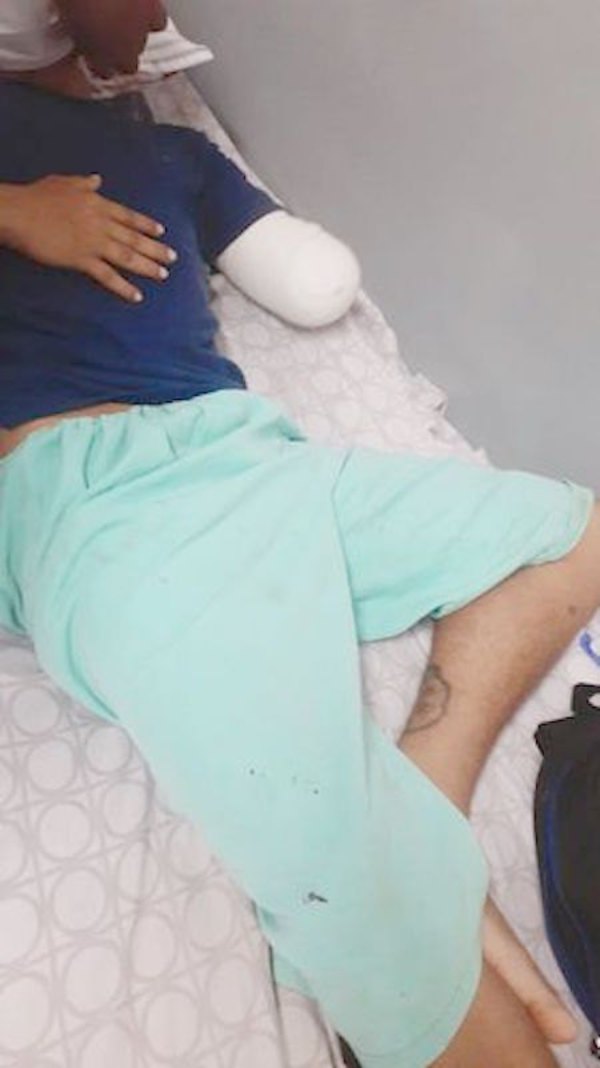 Crónica / Salió a farrear por ahí y volvió ¡sin un brazo!