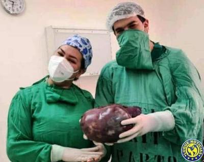 Extraen tumor de 5 kilos de una menor de 14 años •