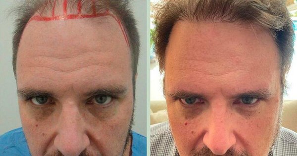 La Nación / Microtrasplante capilar ayuda a las personas a recuperar su esencia y mejorar su autoestima