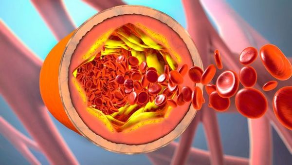 Qué dice la Sociedad Internacional de Trombosis y Hemostasia sobre la vacuna AstraZeneca