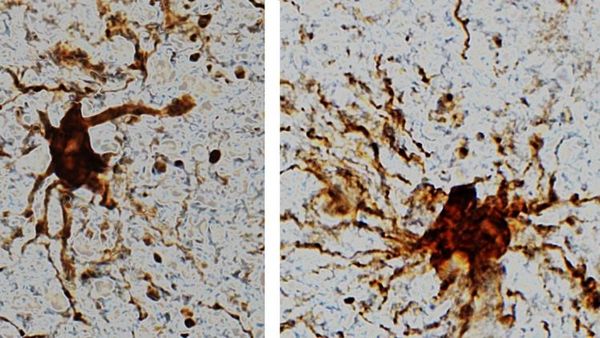 Descubren en el cerebro “células zombis” que continúan creciendo horas después de la muerte