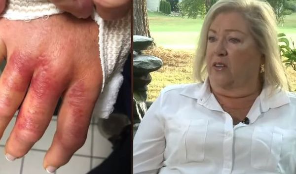 Fue a hacerse la manicura y casi pierde la mano tras contraer bacteria "come carne" - El Trueno