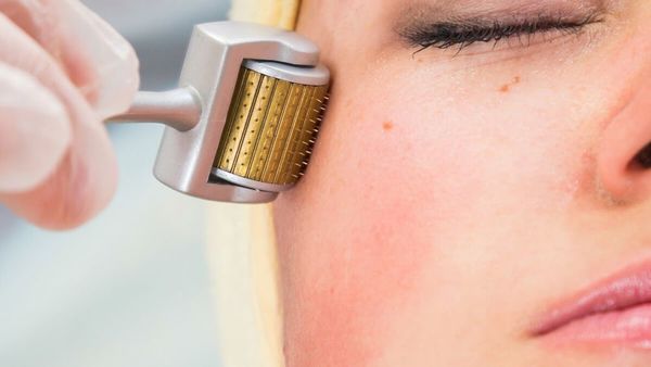 Las microagujas: la herramienta casera para el cutis que se postula ser la favorita del 2021