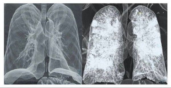 El pulmón de un pos-Covid grave es peor que el de un fumador, según médico