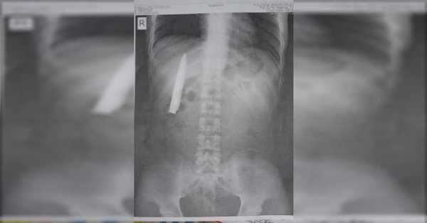 Hombre descubre una hoja de cuchillo dentro de su torso un año después de ser apuñalado - C9N