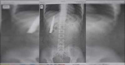 Hombre descubre una hoja de cuchillo dentro de su torso un año después de ser apuñalado - SNT
