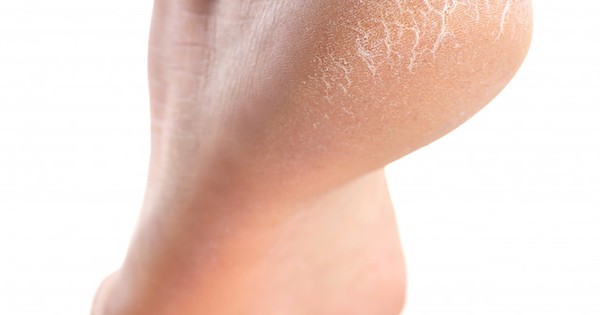 La Nación / Consejos sobre cómo mantener saludable la piel de los pies y evitar talones agrietados