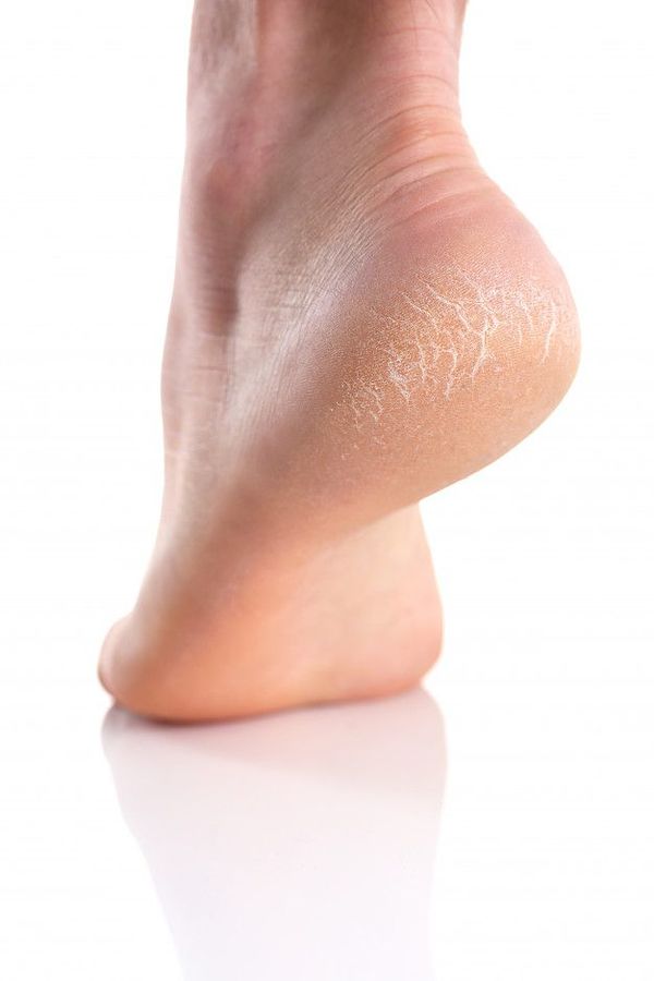 Recomendaciones para mantener la piel de los pies saludable y evitar los talones agrietados - Estilo de vida - ABC Color