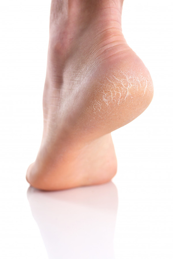 Recomendaciones para mantener la piel de los pies saludable y evitar los talones agrietados | Ñanduti