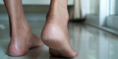 Recomendaciones para mantener la piel de los pies saludable y evitar los talones agrietados » San Lorenzo PY