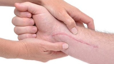 | ¿Cirugías sin cicatrices? Prueban un fármaco conocido que las elimina