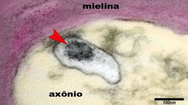 Coronavirus: autopsias revelan por qué es tan difícil diagnosticar covid-19 en niños