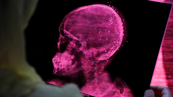Estudio encuentra que el COVID-19 altera el volumen de materia gris en el cerebro | Ñanduti