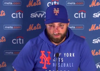 Tras múltiples fracturas luego del pelotazo en la cara, así quedó el beisbolista Kevin Pillar