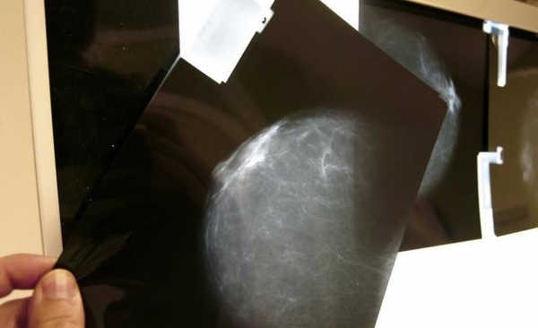 Diario HOY | Un estudio concluye que un tipo cáncer mama se podría curar sin quimioterapia