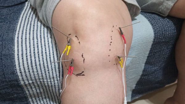 La electroacupuntura como método fisioterapéutico