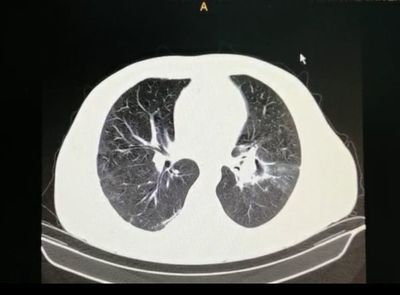 Descubren dos casos de “hongo negro” post coronavirus - Nacionales - ABC Color