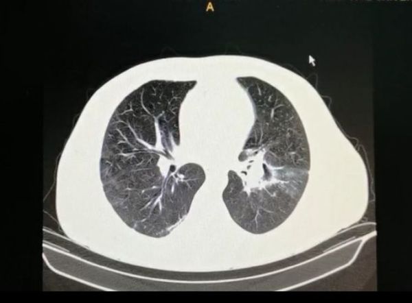 Descubren dos casos de “hongo negro” post coronavirus