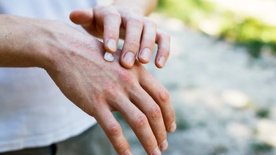 ¿Pueden vacunarse contra el COVID-19 las personas con psoriasis? - Megacadena — Últimas Noticias de Paraguay