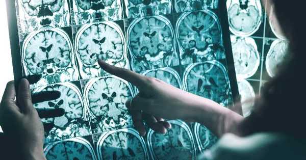 EE.UU. aprobó nuevo medicamento contra el Alzheimer que proporciona un “significativo avance terapéutico” - C9N