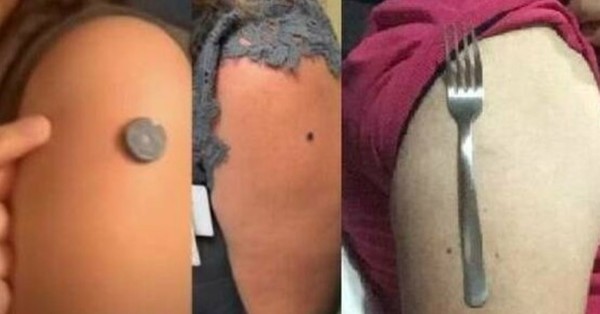Dermatóloga explica el auténtico motivo por el que una moneda u otro metal se puede pegar a la piel - SNT