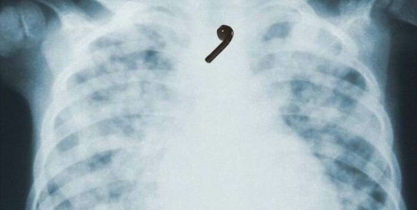 ¿Cómo? Un hombre tragó uno de sus AirPods y el audífono todavía funciona