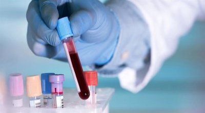 Desarrollan un nuevo test de sangre permite la detección temprana de 50 tipos de cáncer | Ñanduti