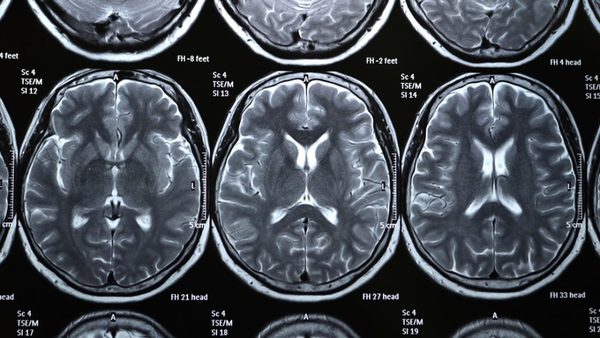 Nuevo estudio concluye que incluso casos leves de COVID podrían conllevar pérdida de materia gris | Ñanduti