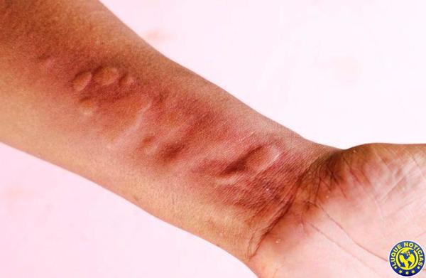 Enfermedades virales pueden presentar síntomas en la piel •