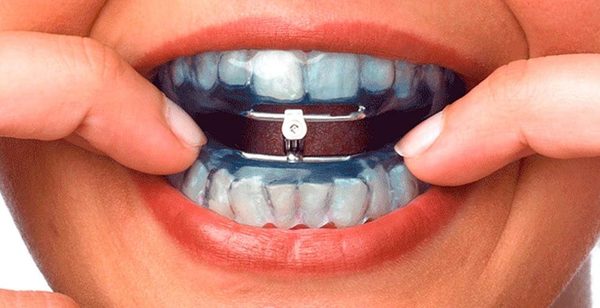 Lucha contra la obesidad: inventan dispositivo que impide abrir la boca para comer