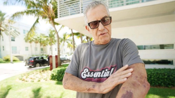 Se salvó “de milagro”: El estremecedor relato de un sobreviviente del derrumbe en Miami