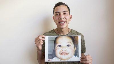 ONG y Clínicas buscan dar asistencia integral a niños con FLAP