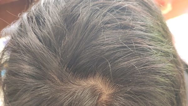 Recomendaciones ante caída del cabello tras cuadro de Covid-19