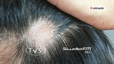 RECOMENDACIONES ANTE CAÍDA DEL CABELLO TRAS CUADRO DE COVID-19