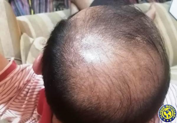 Post Covid-19: Brindan recomendaciones ante caída del pelo •
