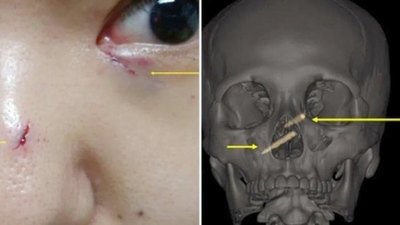 Crónica / Pelea de hermanas terminó con palitos chinos en la cara