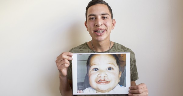 La Nación / Smile Train llegó a Paraguay para ofrecer cirugías y tratamientos de fisuras labio alvéolo palatinas