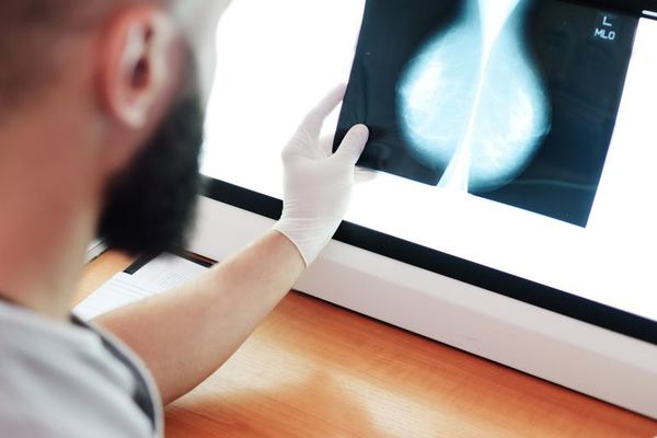La recurrencia del cáncer de mama más agresivo disminuye con inmunoterapia - Ciencia - ABC Color