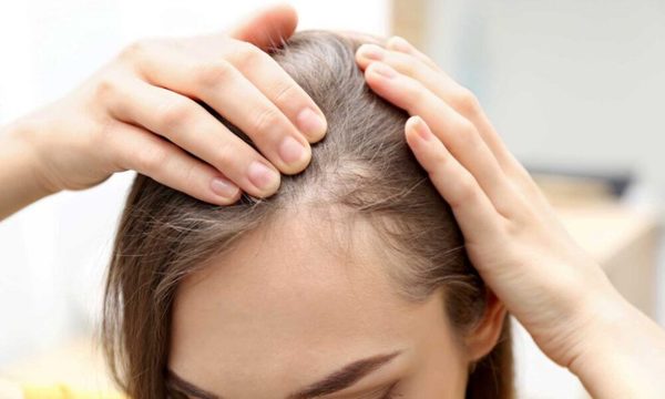 Recomendaciones para tener en cuenta si se sufre de alopecia