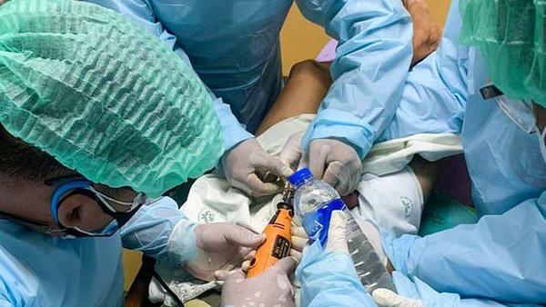 Un tailandés sufrió severas lesiones luego de atascar su pene durante dos semanas en un candado durante un extraño fetiche sexual – Prensa 5