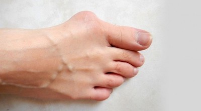 Juanetes: qué son, tratamientos y prevención