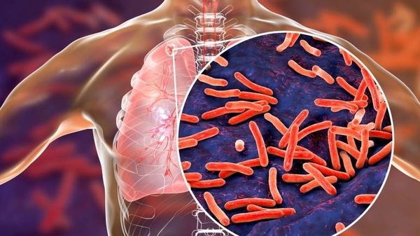Diario HOY | Sancionan ley que establece protección a los pacientes con tuberculosis
